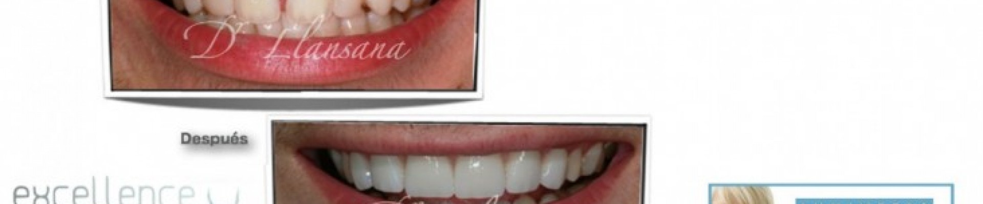 Carillas cerámicas Lumineers en Excellence Dental