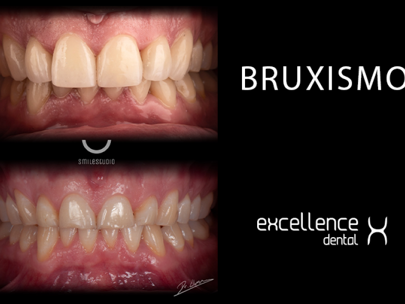 Bruxismo y ortodoncia, evita el desgaste dental